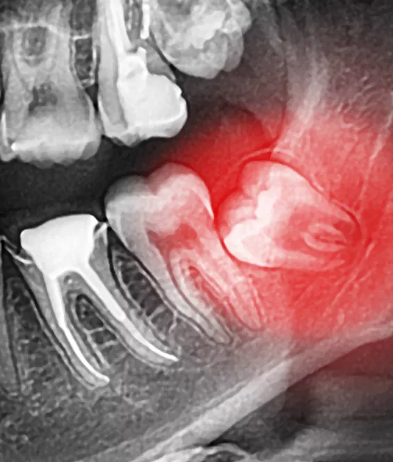 wisdom teeth diagram